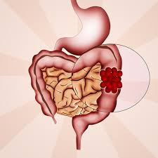 Colorectal Cancer NGS  Panel