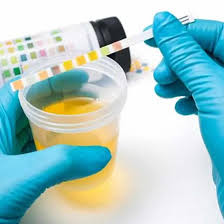 Sodium (Na) Random Urine  Test