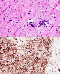 CNS/Glioma NGS  Molecular Panel